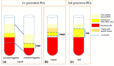 PRF vs PRP in dentistry. Which one is better | Dental Iceberg