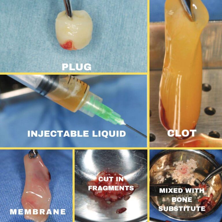 Clinical Application Of Platelet Rich Fibrin In Dental Implantology