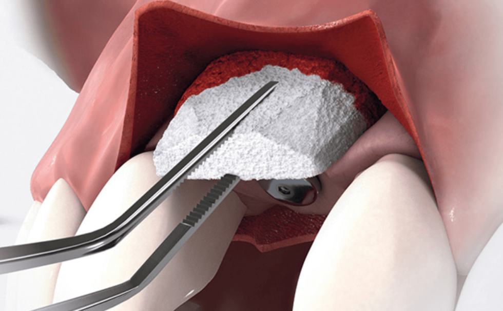 Soft Tissue Replacement Materials Dental Iceberg