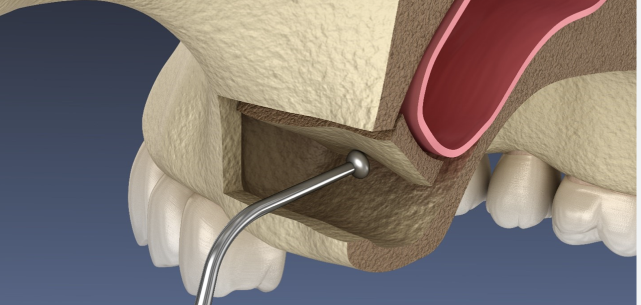 Complications in sinus liftingSinus lift course Dental Iceberg