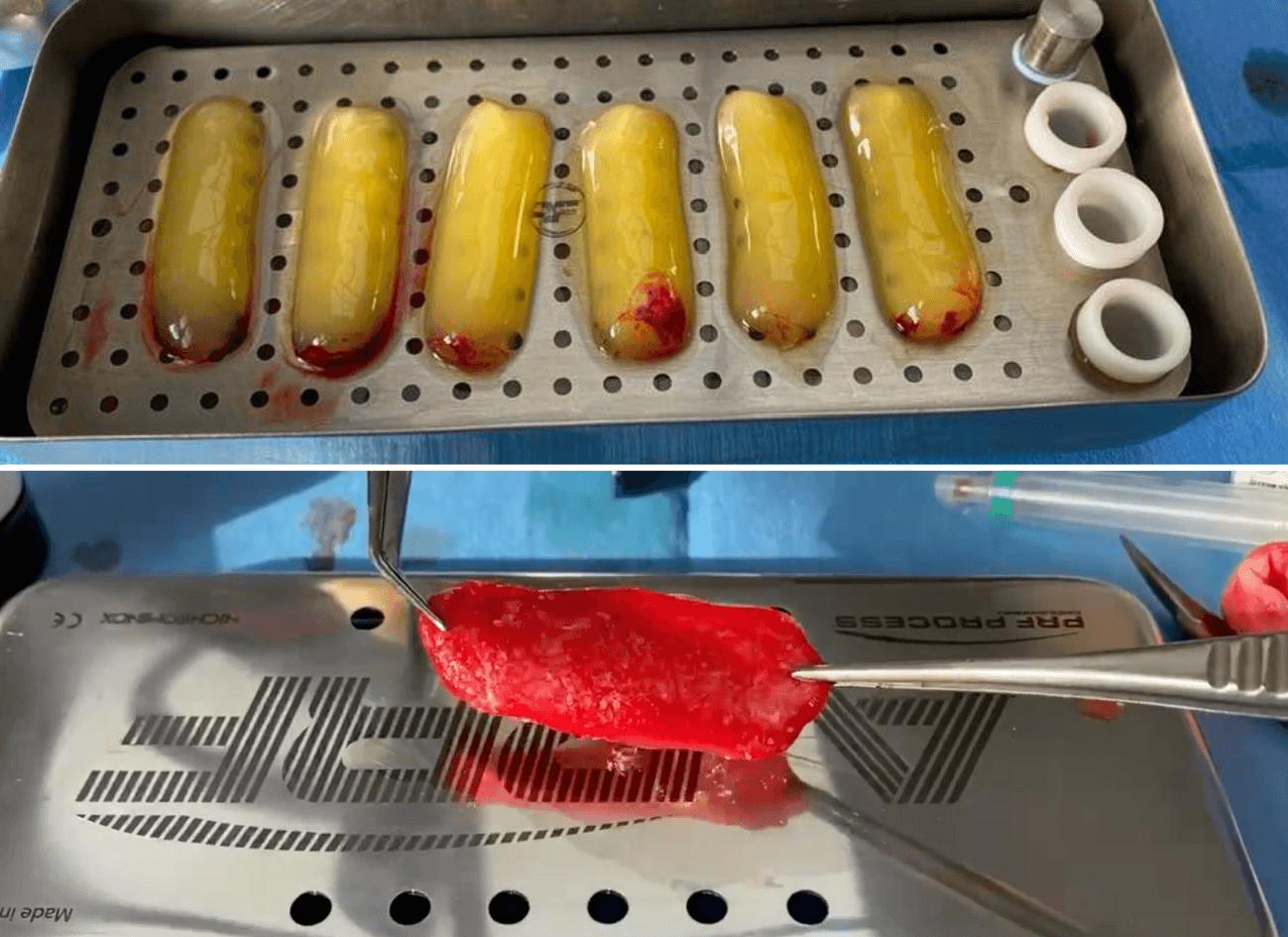 thumbnail image 2 of DDP PRF & GRF System Dental Implant Kit - Platelet Rich Fibrin, Stainless Steel, DN-316 2 of 6