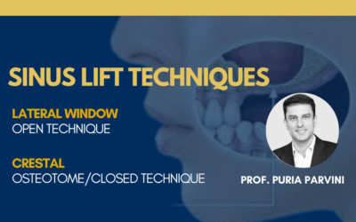Mastering Sinus Lift Techniques: A Guide for Implant Dentists