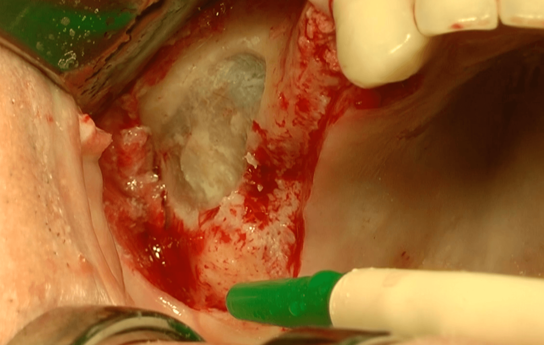 sinus grafting